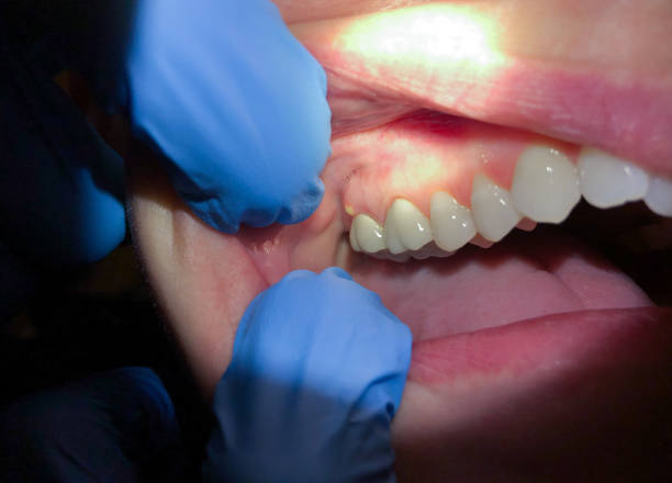 Best Emergency Wisdom Tooth Extraction in Third Lake, IL